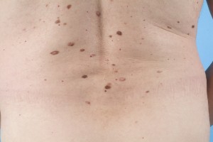 Atypische nevus verzameling rug