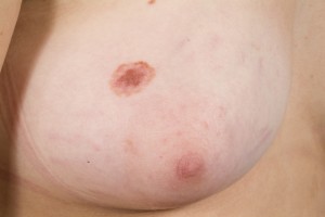 atypische nevus borst (cocarde type)